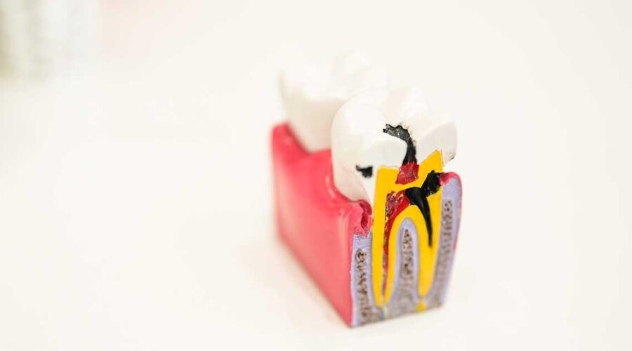 The Root Canal Debate: Risks & Alternatives